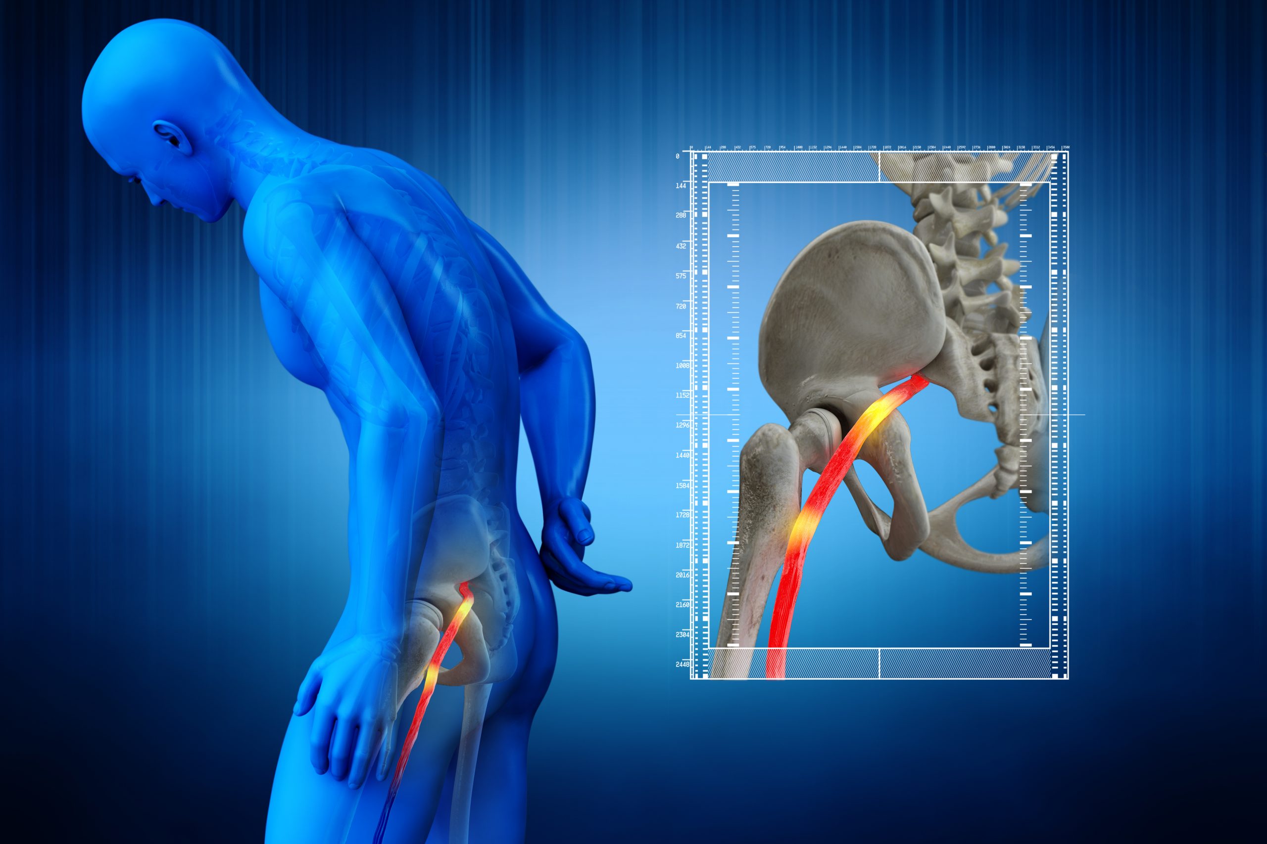 sciatica pain relief hong kong